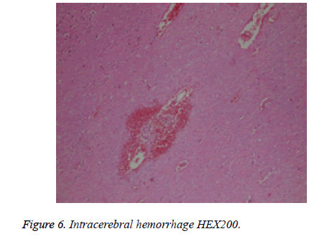 biomedres-hemorrhage-Intracerebral