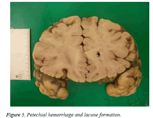 biomedres-hemorrhage-lacune-formation