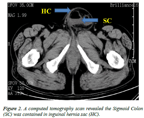 biomedres-hernia-sac