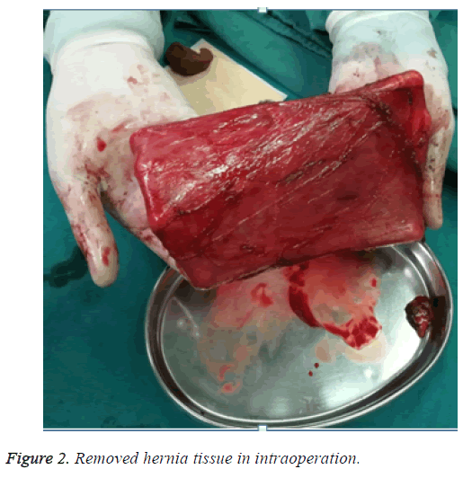 biomedres-hernia-tissue