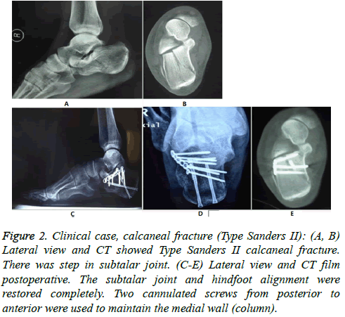 biomedres-hindfoot-alignment