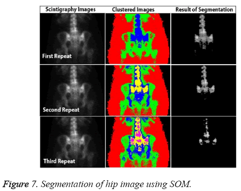 biomedres-hip-image-using-SOM