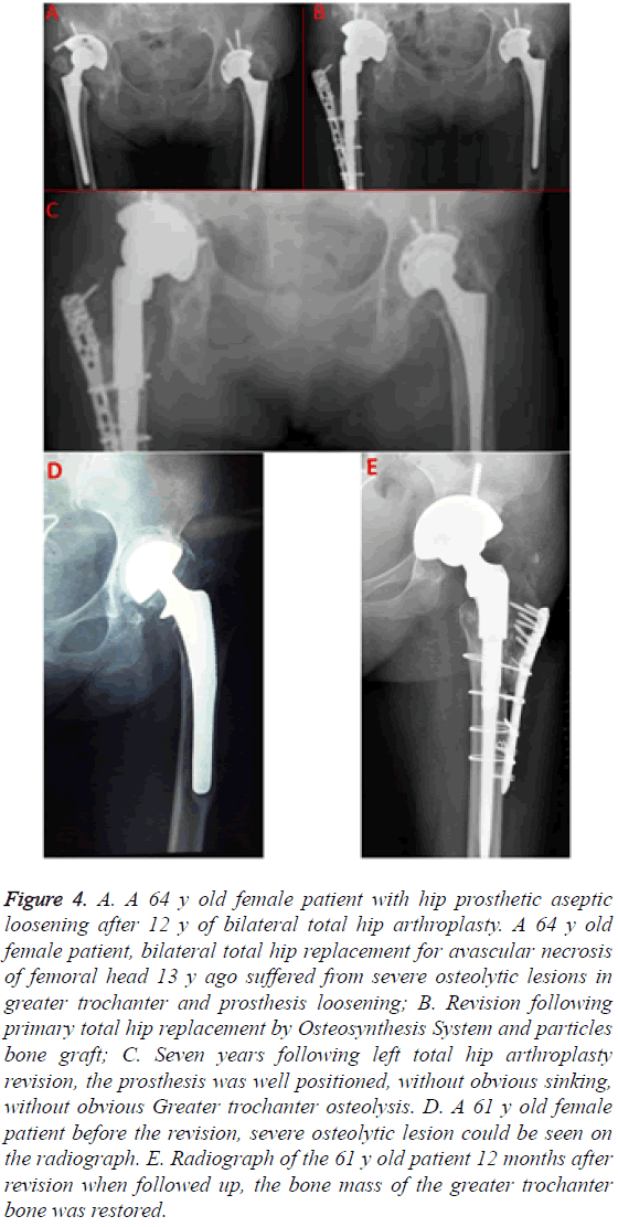 biomedres-hip-prosthetic-aseptic