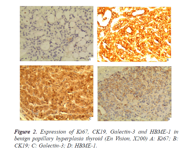 biomedres-hyperplasia-thyroid