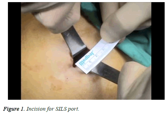 biomedres-incision-SILS-port