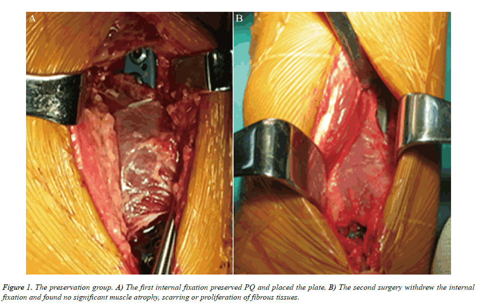 biomedres-internal-fixation-preserved