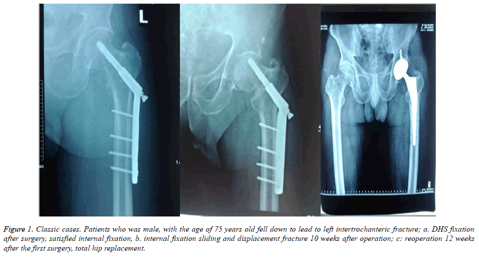 biomedres-intertrochanteric-fracture