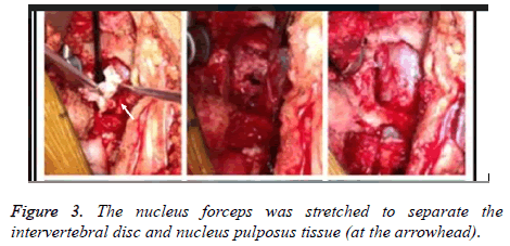 biomedres-intervertebral-disc