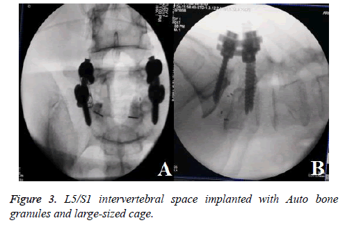 biomedres-intervertebral-space