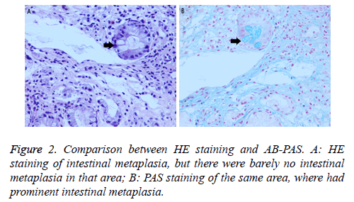 biomedres-intestinal-metaplasia