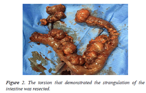 biomedres-intestine-resected