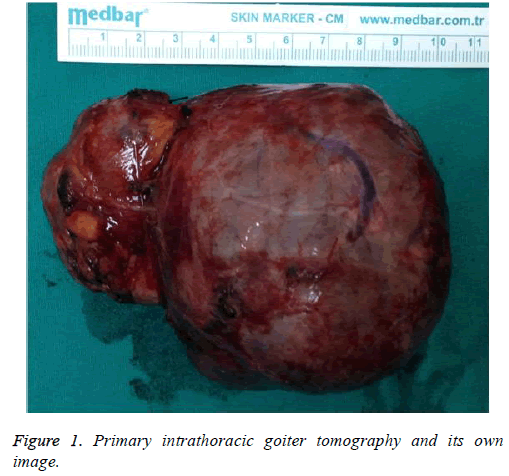 biomedres-intrathoracic-goiter