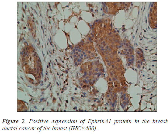 biomedres-invasive-ductal-cancer