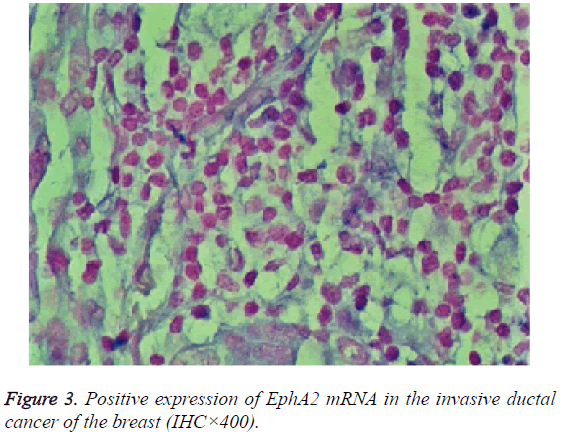 biomedres-invasive-ductal-cancer