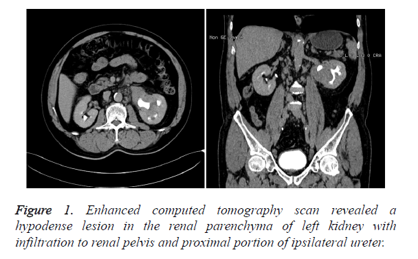 biomedres-ipsilateral-ureter