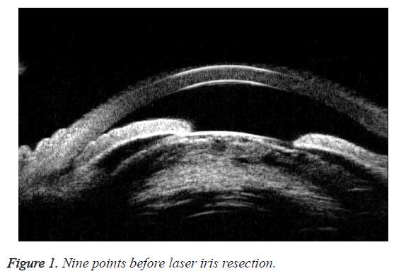 biomedres-iris-resection