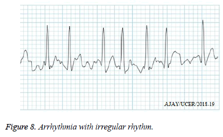 biomedres-irregular-rhythm