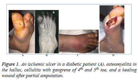 biomedres-ischemic-ulcer