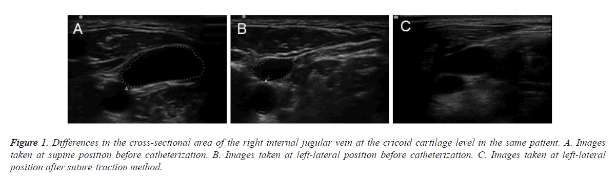 biomedres-jugular-vein