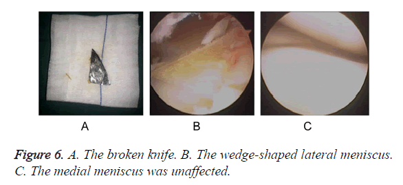 biomedres-lateral-meniscus