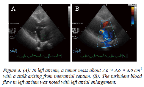 biomedres-left-atrium