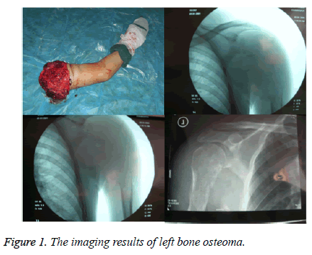 biomedres-left-bone