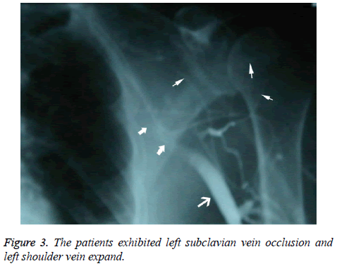 biomedres-left-subclavian