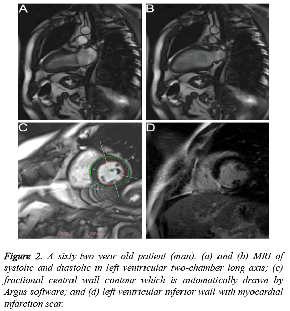 biomedres-left-ventricular-inferior