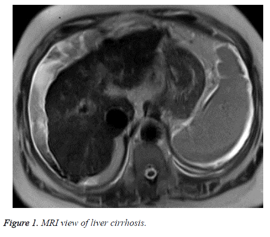 biomedres-liver-cirrhosis