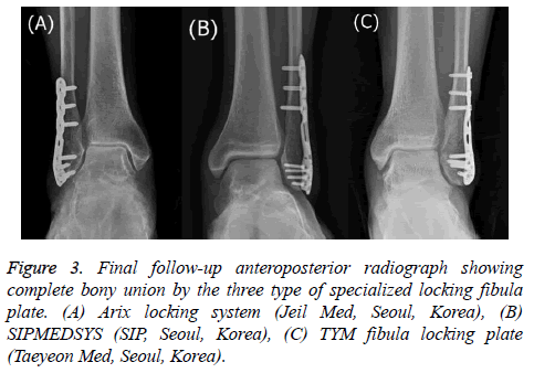 biomedres-locking-fibula