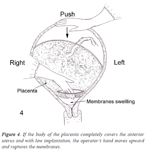 biomedres-low-implantation