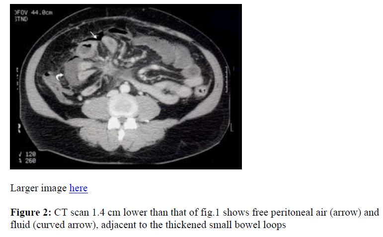 biomedres-lower-free-peritoneal-air-fluid