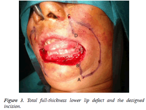 biomedres-lower-lip