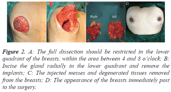 biomedres-lower-quadrant-breasts