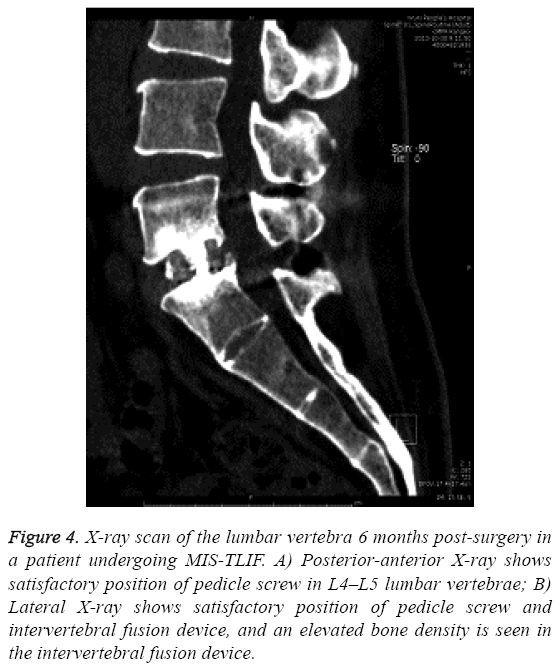 biomedres-lumbar-vertebra-6-months