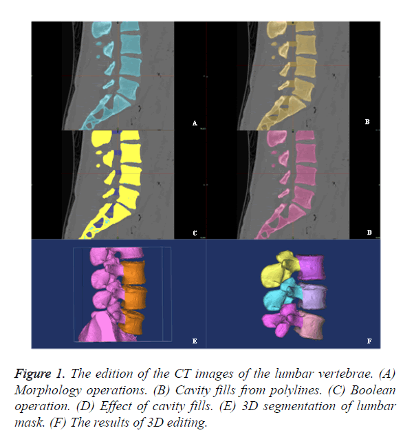 biomedres-lumbar-vertebrae