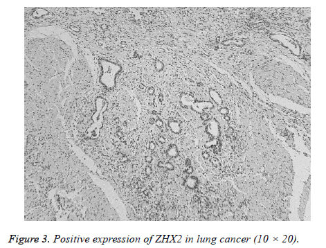 biomedres-lung-cancer