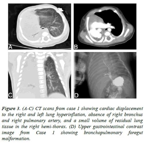 biomedres-lung-hyperinflation