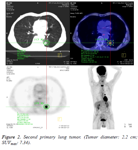 biomedres-lung-tumor