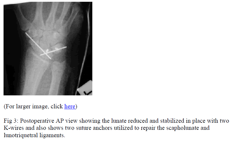 biomedres-lunotriquetral-ligaments