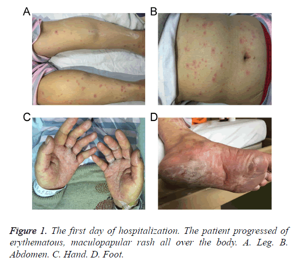 biomedres-maculopapular-rash