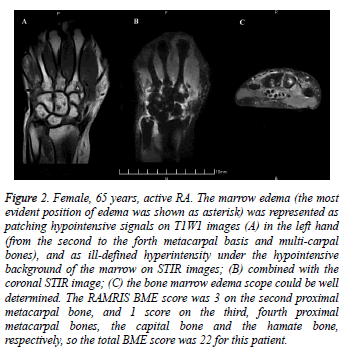 biomedres-marrow-edema