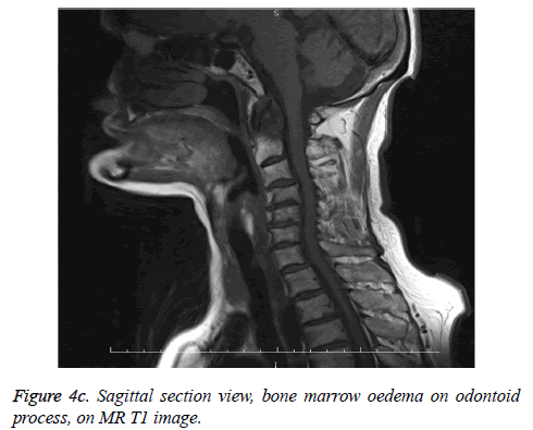 biomedres-marrow-oedema