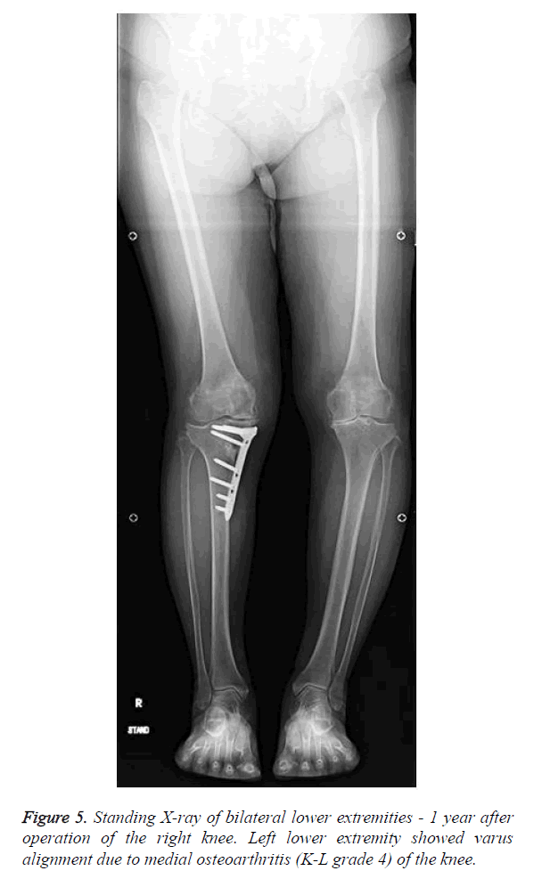 biomedres-medial-osteoarthritis