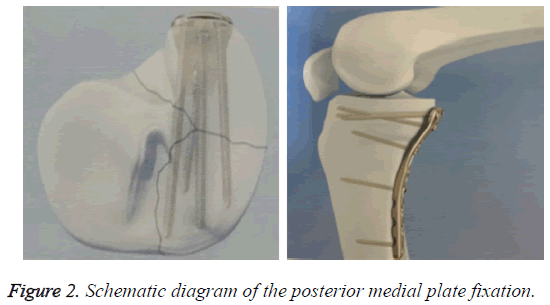 biomedres-medial-plate-fixation