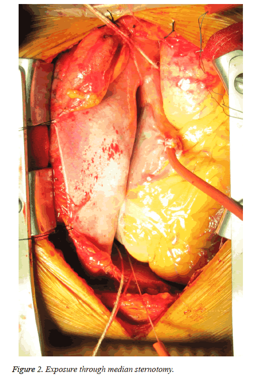 biomedres-median-sternotomy