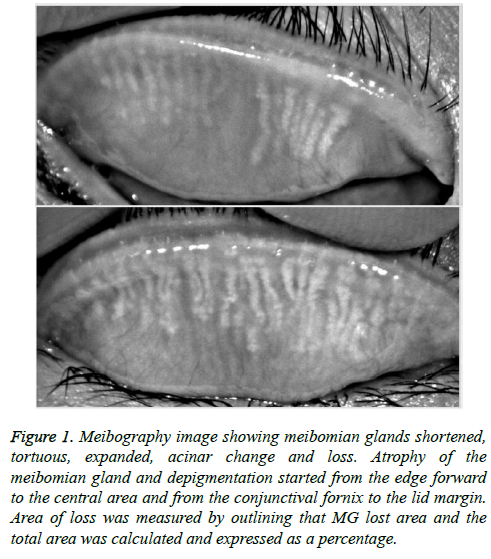 biomedres-meibomian-glands