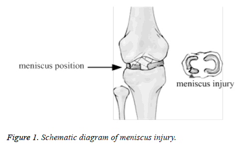 biomedres-meniscus-injury