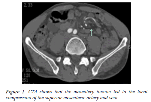 biomedres-mesentery-torsion