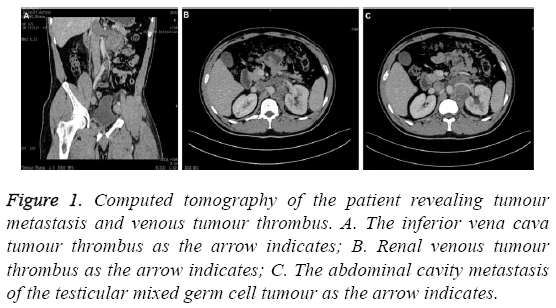 biomedres-mixed-germ-cell-tumour